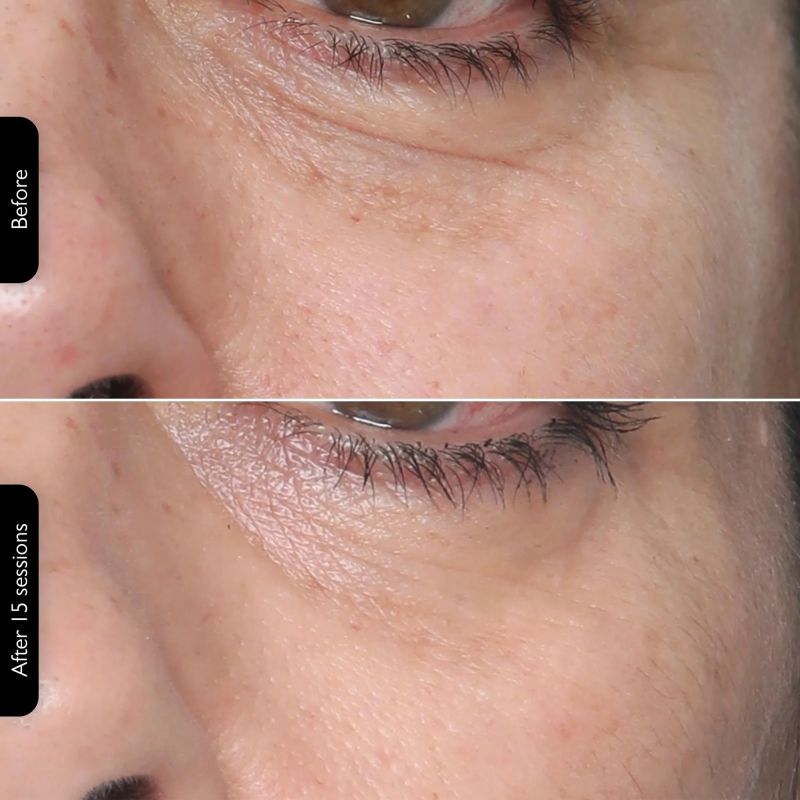 Silkn FTMP1PE1001 FaceTite MultiPlatform