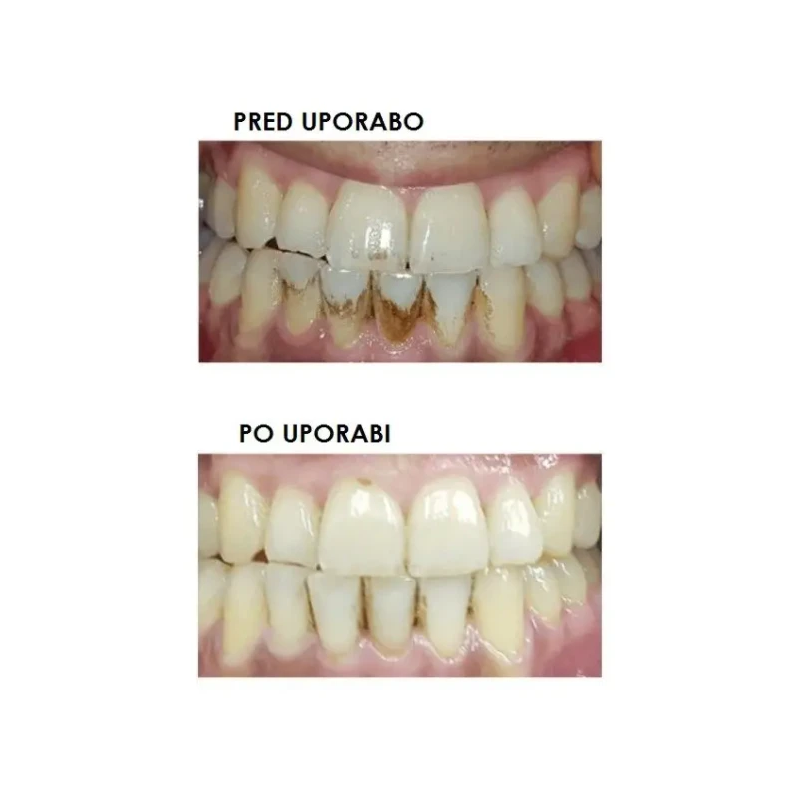 Silkn ToothWave TW1PE3001