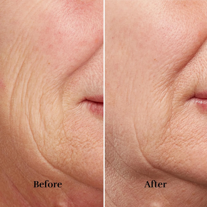 Silkn FaceTite Revive FTC1PE1001